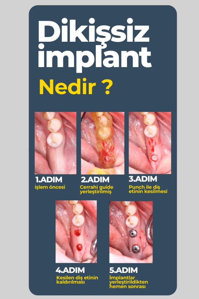 yerli implant fiyatları 2024