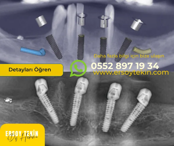 all-on-four-implant-fiyatlari