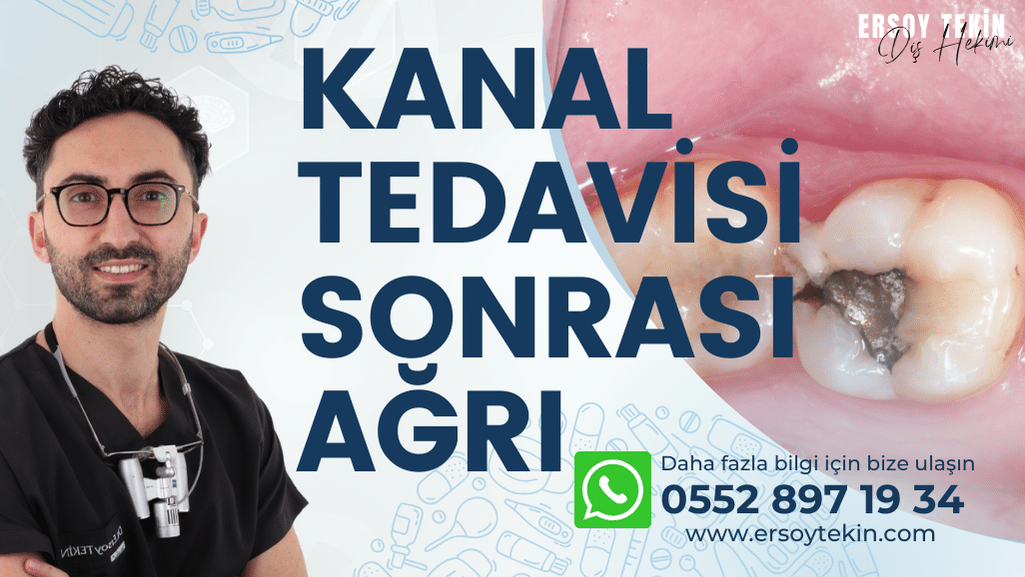 Kanal Tedavisi Sonrası Diş Üstüne Basamama