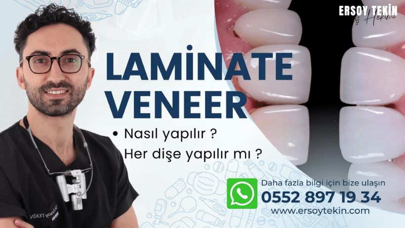 laminate veneer nedir