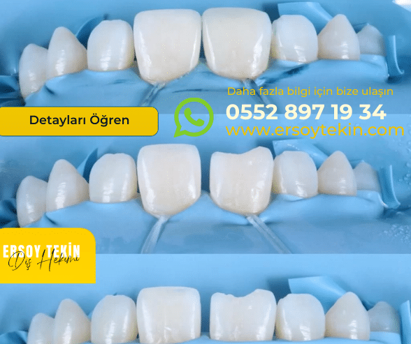 Bonding Diş Fiyatları 2025