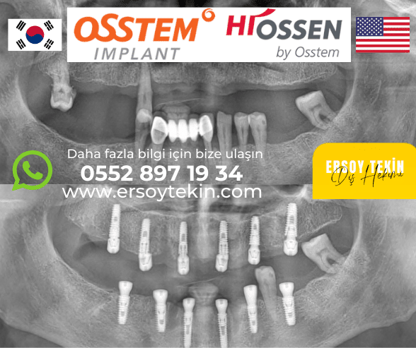 Osstem ve Hiossen İmplant Fiyatları