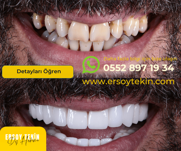 Gülüş Tasarımı Fiyatları 2025