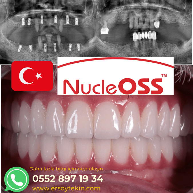 NucleOSS İmplant Fiyatları 2023